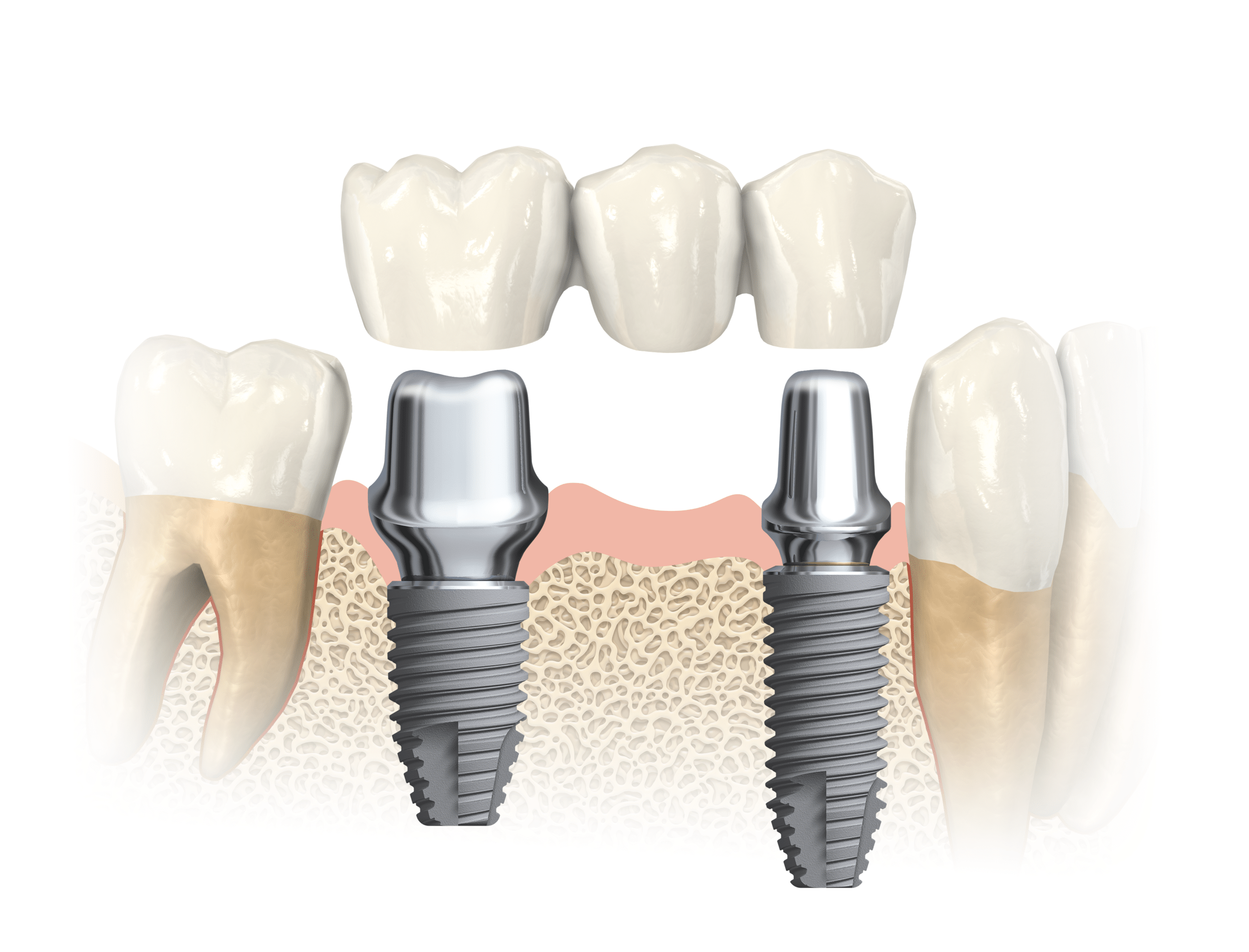 264-multiple-teeth-implants.png