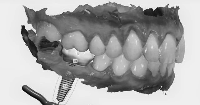 025640338301-dgital-dental-implant-planning-bone-graf-screw-retained-or-cement-retained-resto.jpg