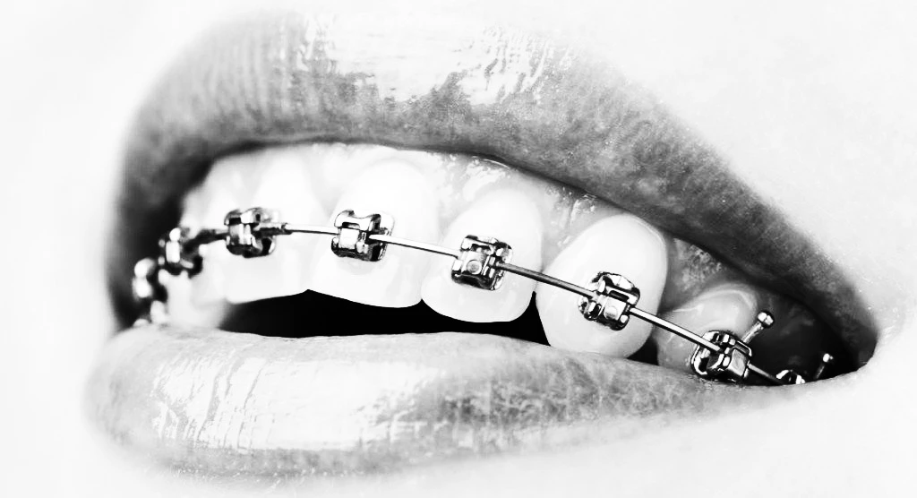 293-understanding-metal-braces.jpg