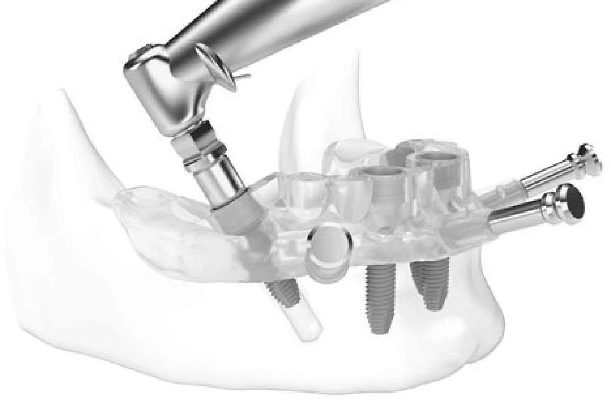 301-digitally-guided-implant-surgery-17253075839524.jpg