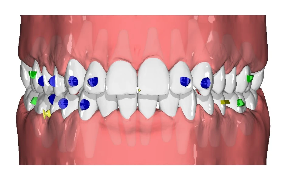 3D ПЛАНИРАНЕ НА ВАШЕТО ОРТОДОНТСКО ЛЕЧЕНИЕ
