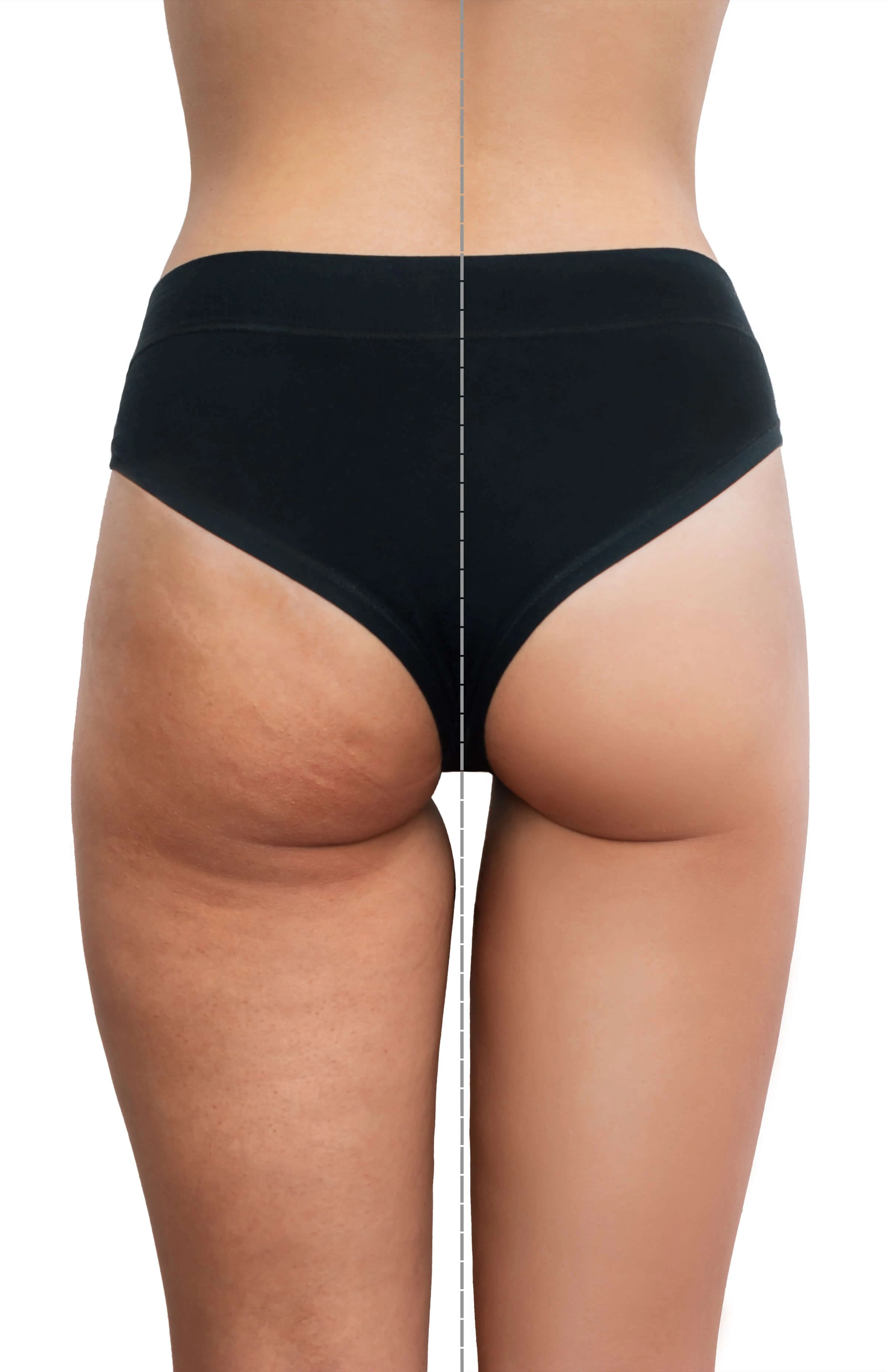 1414-comparison-young-woman-s-thighs-buttocks-with-cellulite-before-after-treatment-16979066053722.jpg