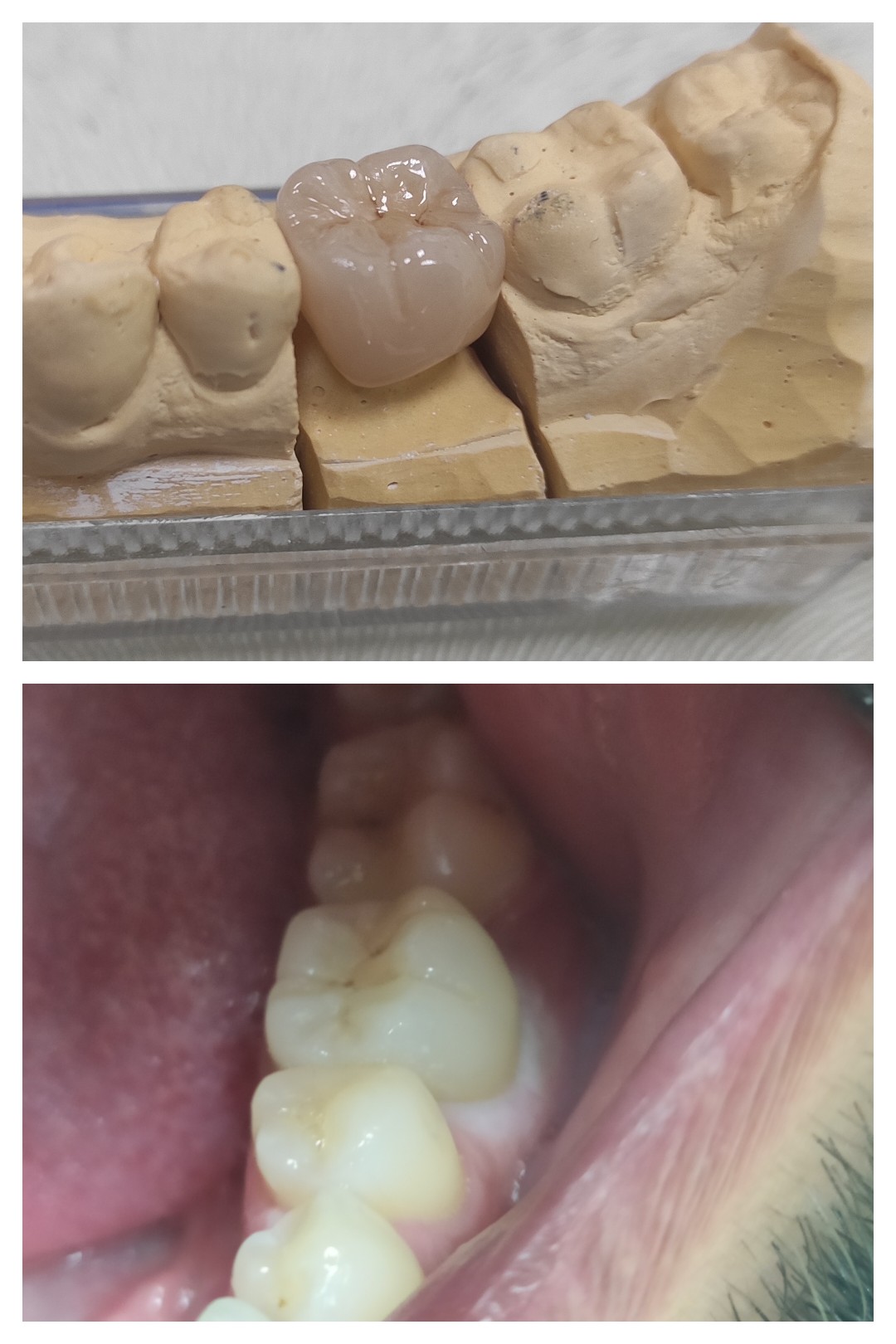 Full Contour Циркониева Корона 14-1633200033504-1.jpg