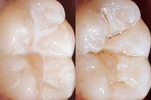 157-dental-sealantsoptimal.jpg