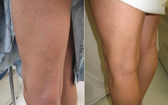 8017-1287-005613501436-sclerotherapy-patient-11-1744976880875.jpg