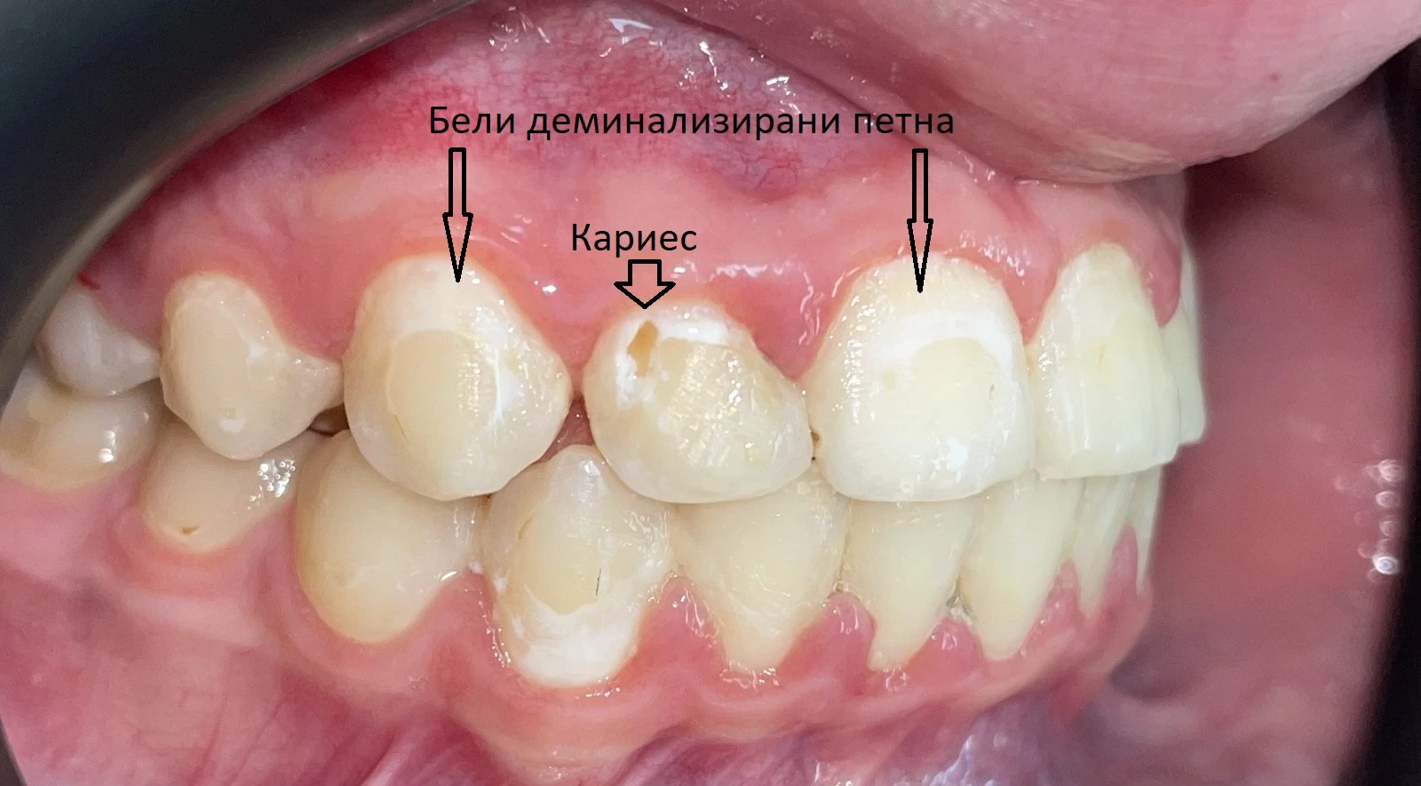 бели петна и кариес след ортодонтско лечение