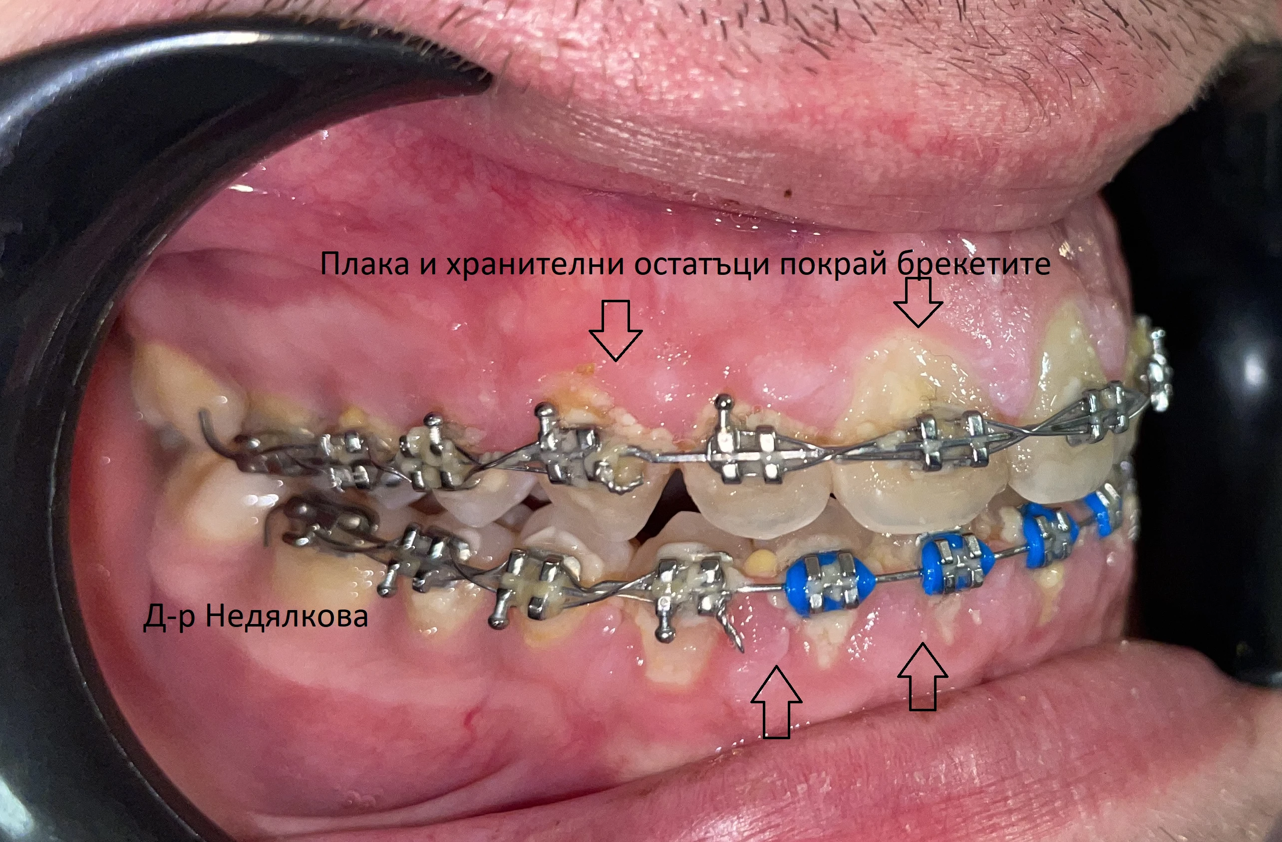 Хранителни остатъци брекети