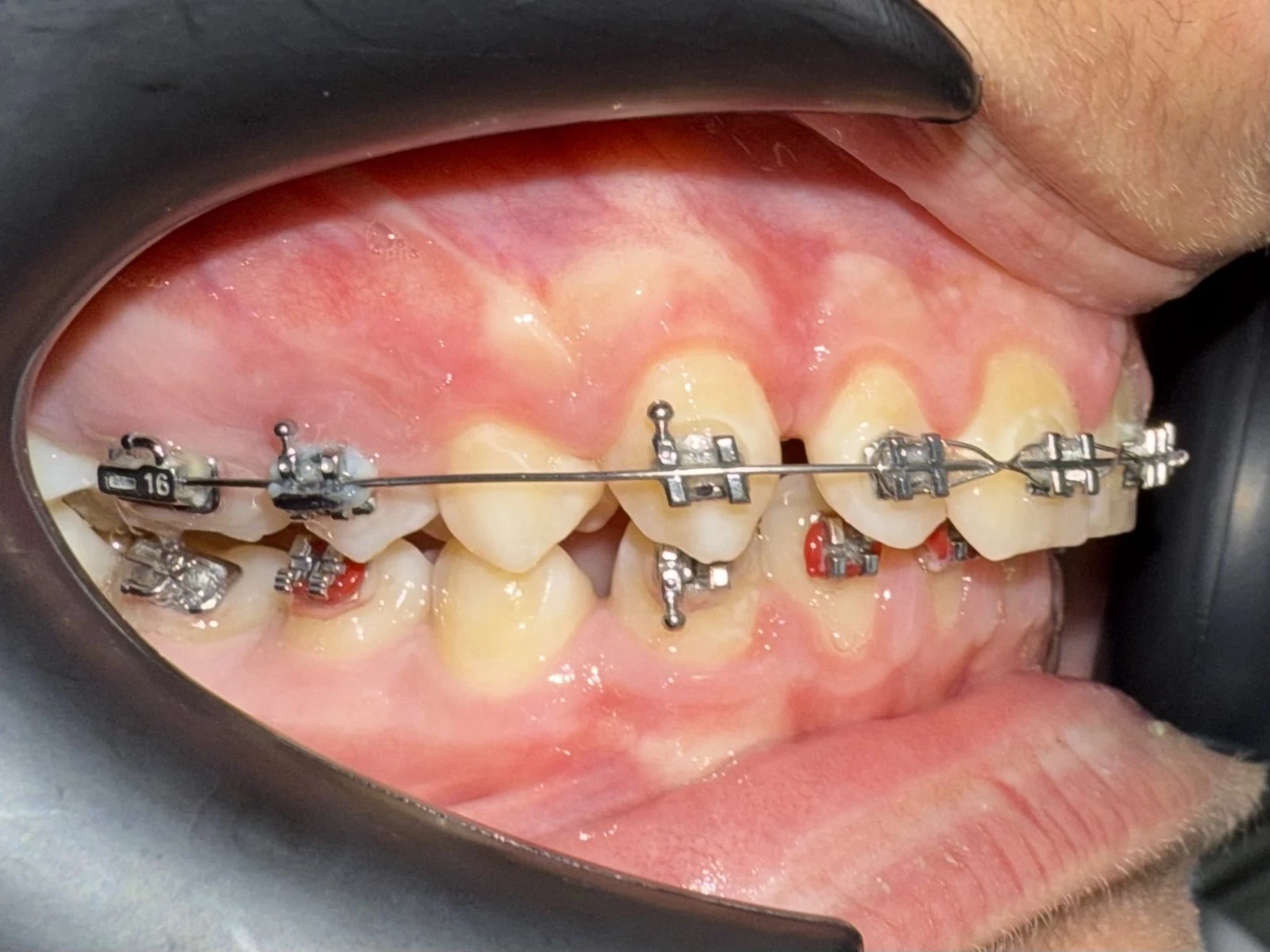 Пациент с много паднали брекети