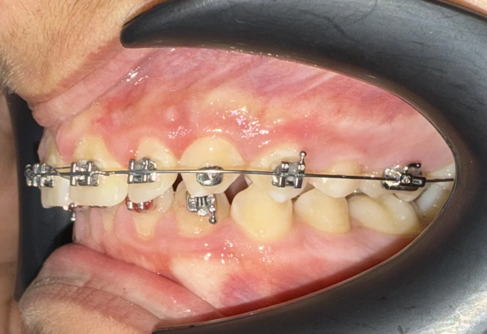 Паднали множество брекети и махната от пациента дъга