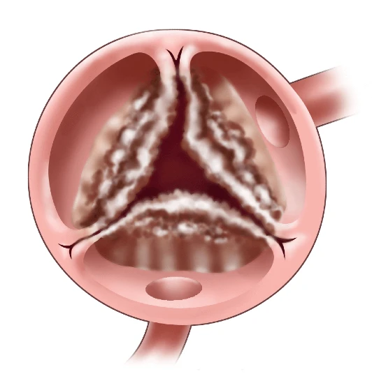 158-aortic-valve-stenosis-interior-16959330979547.jpg