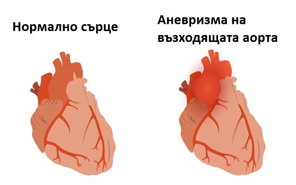 324-ascending-aortic-aneurysm-heart-valve-disease-16963448704282.jpg