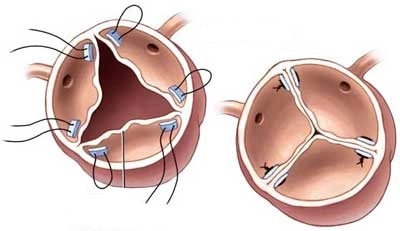 343-repair-aortic-valve-1-16964118767182.jpg