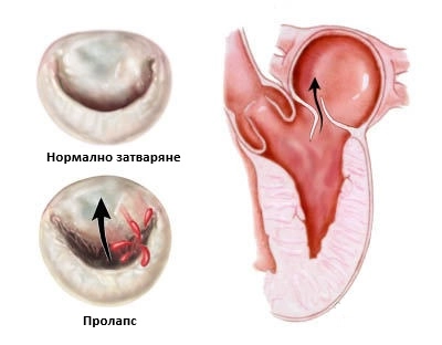 352-mitral-valve-prolapse-16966132282558.jpg