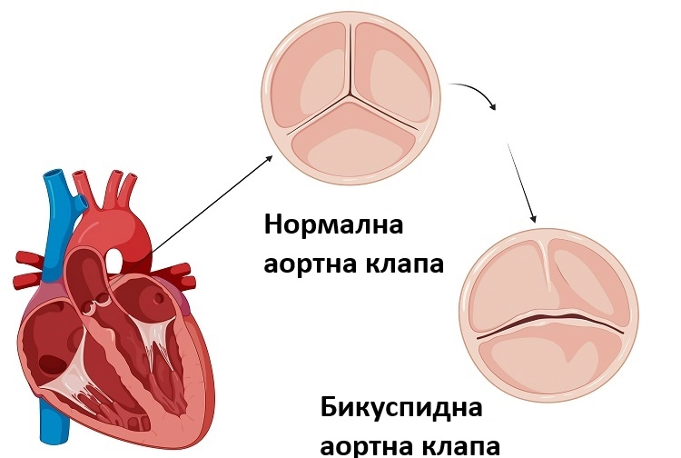 386-bicuspid-aortic-valve-16968735646939.jpg