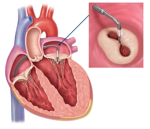 441-mitraclip-diagram-16984037810541.jpg