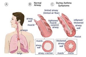473-asthmadiagram-300x1991.jpg