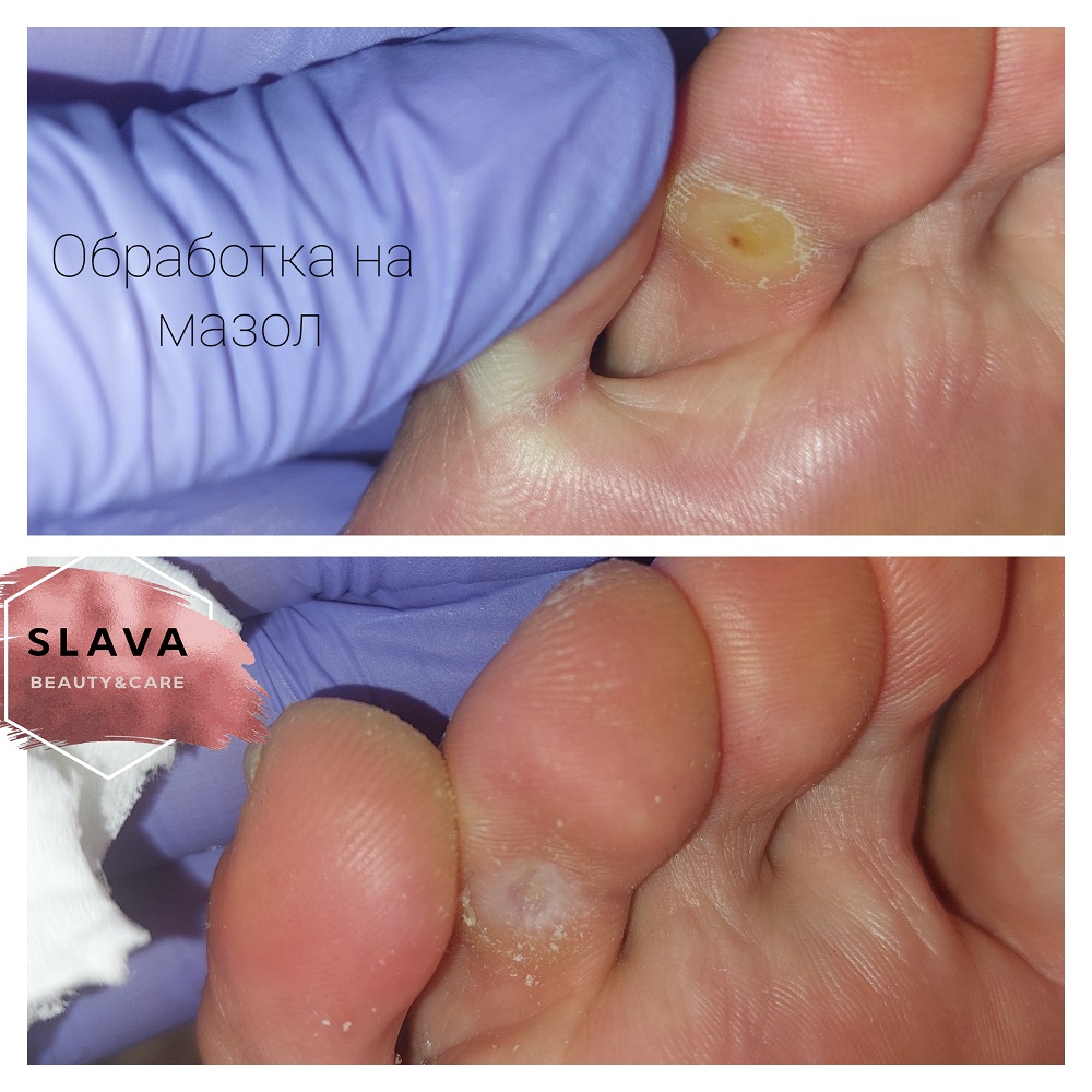 328-терапевтичен-педикюр-обработка-на-целувчен-мазол.jpg