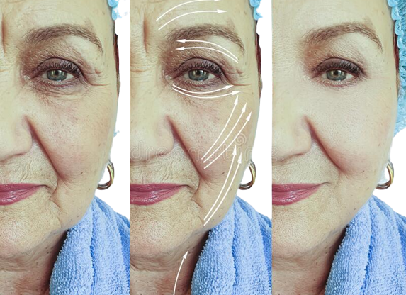 0115734161253-face-old-woman-wrinkles-problem-lifting-difference-collagen-arrow-treatment-effe.png