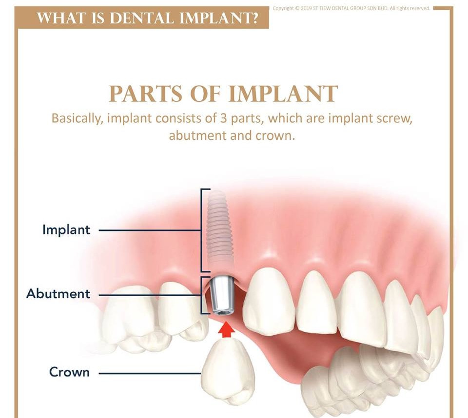 0179608581232-what-is-dental-implant-02.jpg