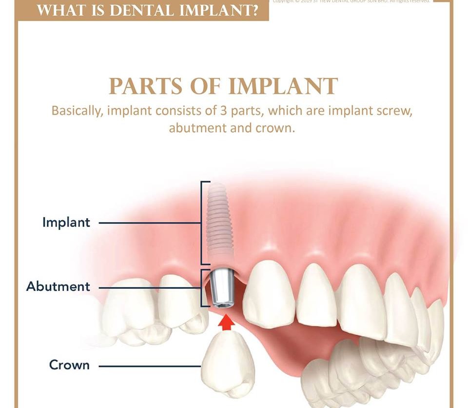 0339608361407-what-is-dental-implant-02.jpg