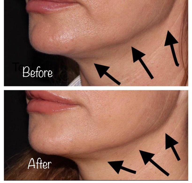 0358187772032-jowl-before-and-after.jpg