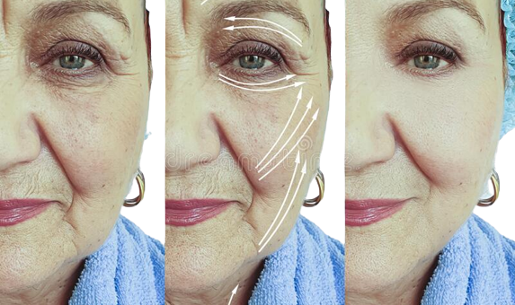 048573340808-face-old-woman-wrinkles-problem-lifting-difference-collagen-arrow-treatment-effe.png