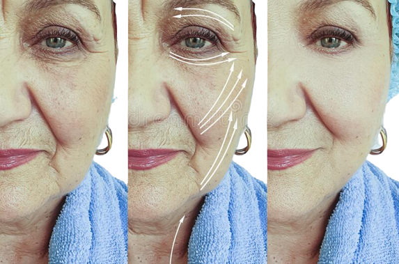 0565733792150-face-old-woman-wrinkles-problem-lifting-difference-collagen-arrow-treatment-effe.png