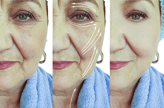 056573379808-face-old-woman-wrinkles-problem-lifting-difference-collagen-arrow-treatment-effe.png