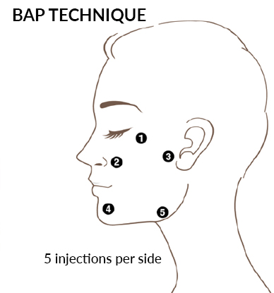 368-profhilo-bap-technique.jpg